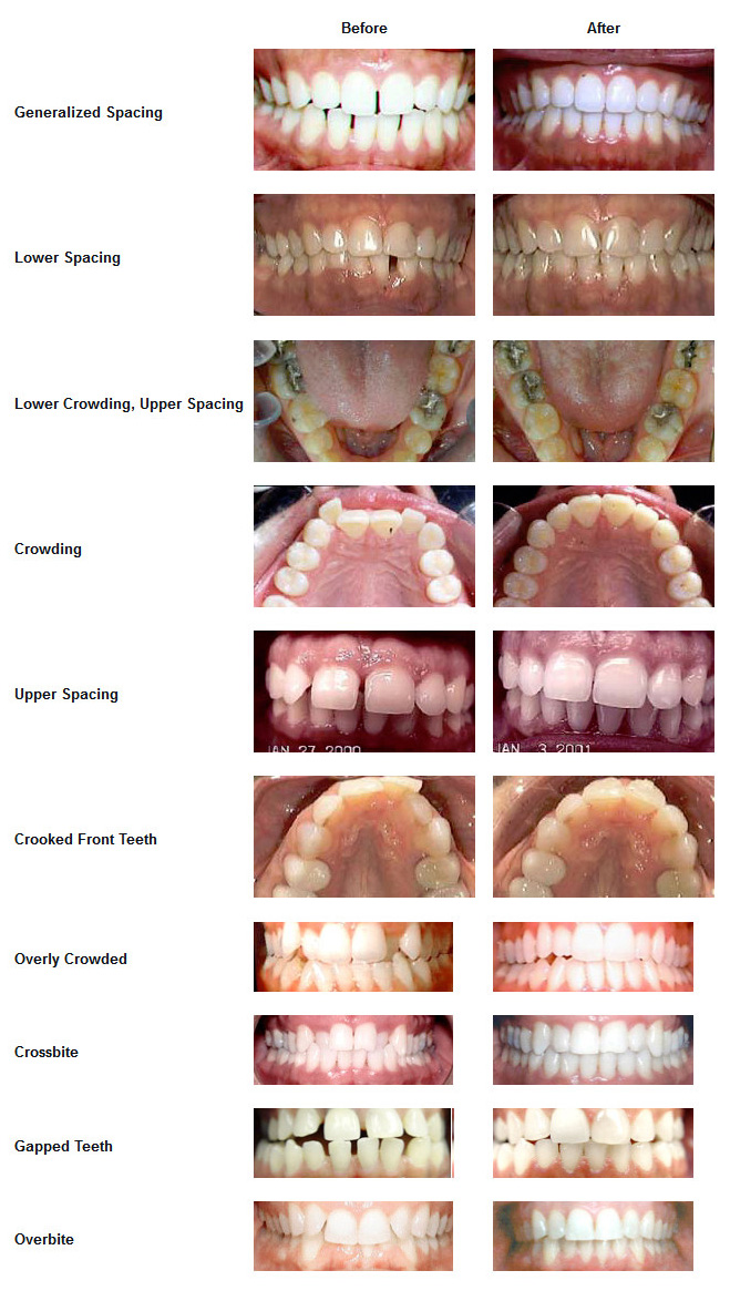 Invisalign Before and After Photos