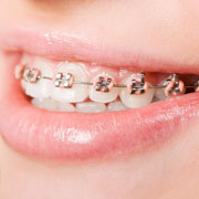 Invisalign vs. Braces