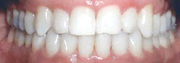 Crossbite After Photos