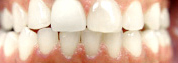 Gapped Teeth After Photos
