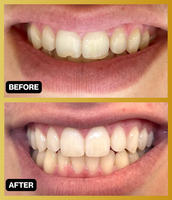Before-and-after smile photographs from Encino Smile Makeover