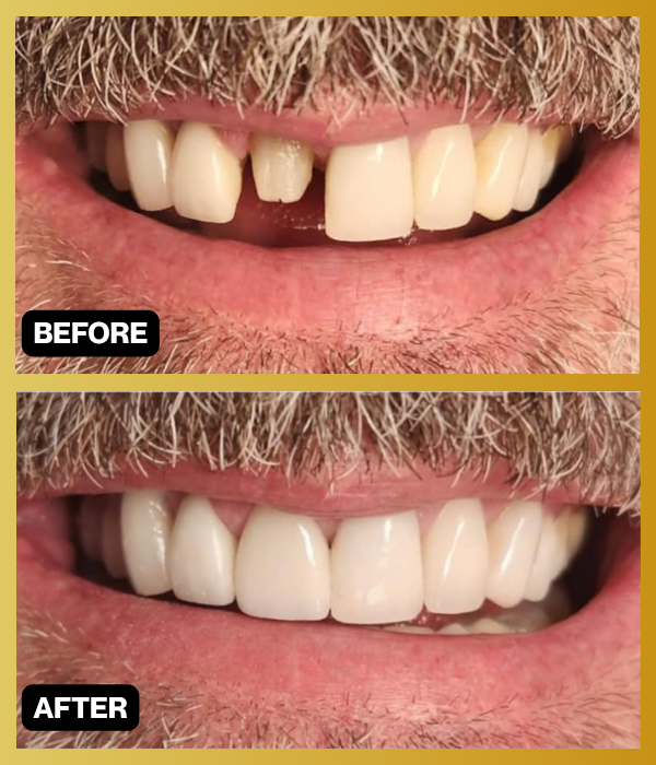 Before-and-after photographs of a restored smile from Encino Smile Makeover