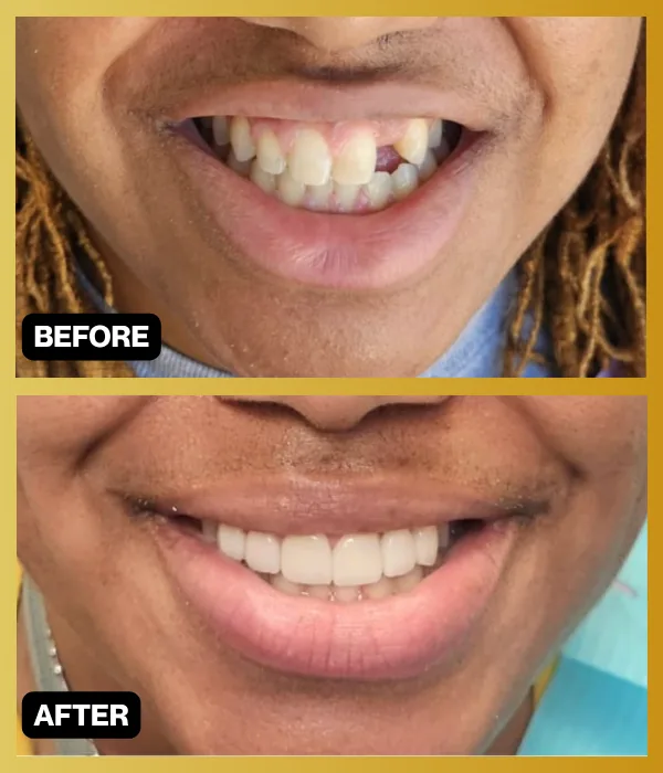 Before-and-after smile makeover photographs from Encino Smile Makeover