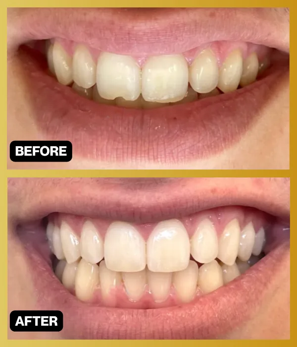 Before-and-after smile photographs from Encino Smile Makeover