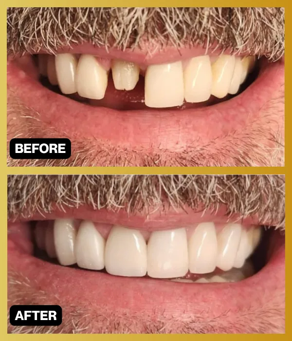 Before-and-after photographs of a restored smile from Encino Smile Makeover
