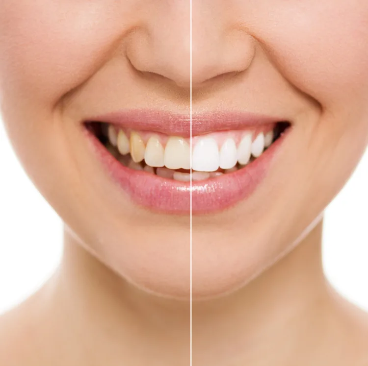 Treatment Options for Yellow Teeth Treatment Options for Yellow Teeth